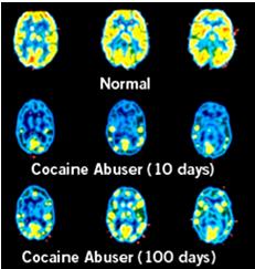 Long term compulsive drug use can produce a phenomenon called hypofrontality in which the metabolic activity of the prefrontal