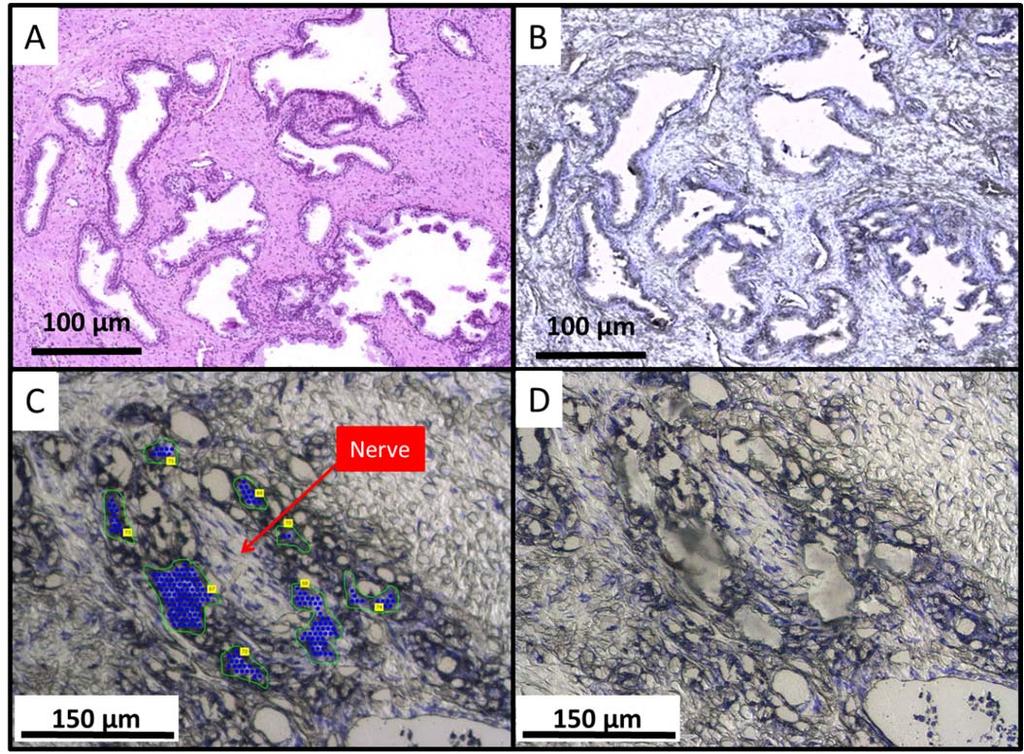 Figure 31: Staining and dissection of human prostate tissue. (A) H&E stain and (B) cresyl violet stain from serial sections.