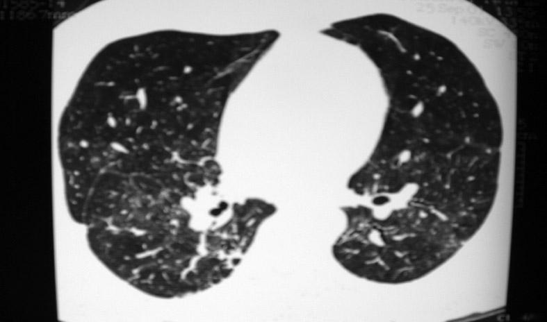 These included non-specific inflammatory changes and a nodular infiltrate in one pilot. FIGURE 3 H&E stain of right upper lobe trans-bronchial lung biopsy showing granulomata.