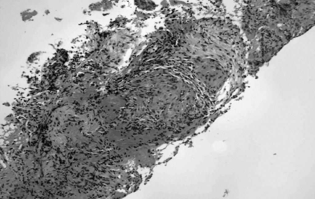 without mediastinal lymphadenopathy Two pilots had abnormal DTPA lung clearance studies, and granulomata were observed in the trans-bronchial lung biopsy that one pilot had (see Figure 3).