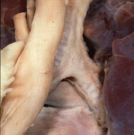Bronchial Arteries Arterial