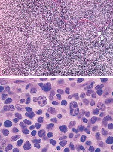 A. FOLLICULAR LYMPHOMA CC/HPI: A 54-year-old white female notices painless lumps bilaterally in her neck that have slowly enlarged over the past three months.