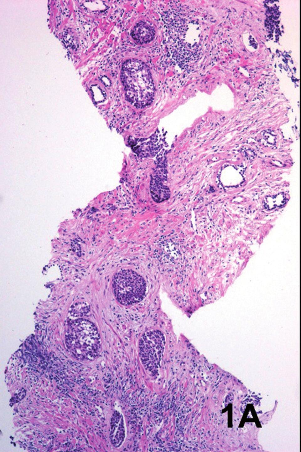 ibju Low grade urothelial carcinoma in prostate biopsy diagnosis in case 1 was low-grade urothelial carcinoma in situ. Case 2 corresponded to an in situ carcinoma with probable stromal infiltration.