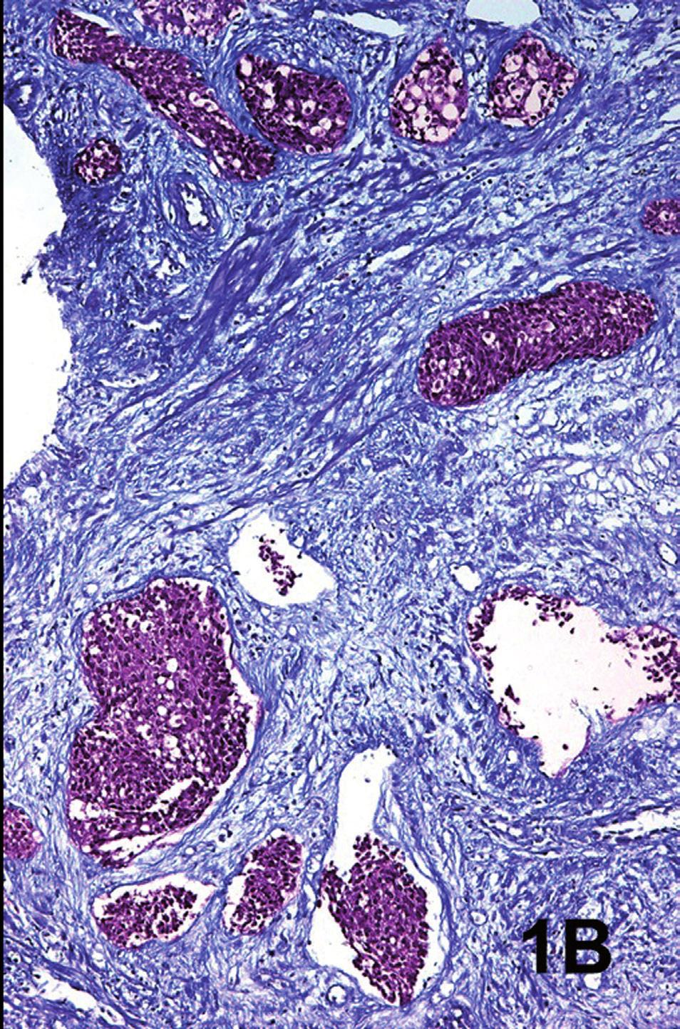 In both cases the tumor showed nests similar to those observed in the needle biopsies as well as cords of neoplastic cells with a clear infiltrative pattern that was not evident in the needle