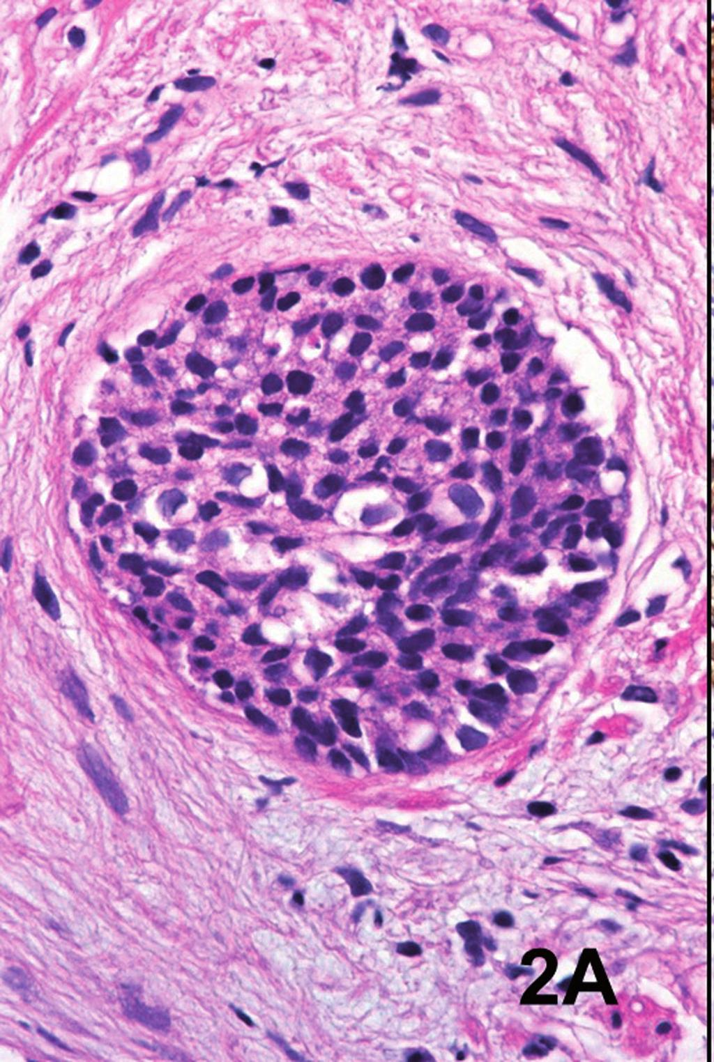 Areas with high-grade urothelial carcinoma were not found. In case one, the neoplasm infiltrated the lamina propria, and in case two the muscular layer.
