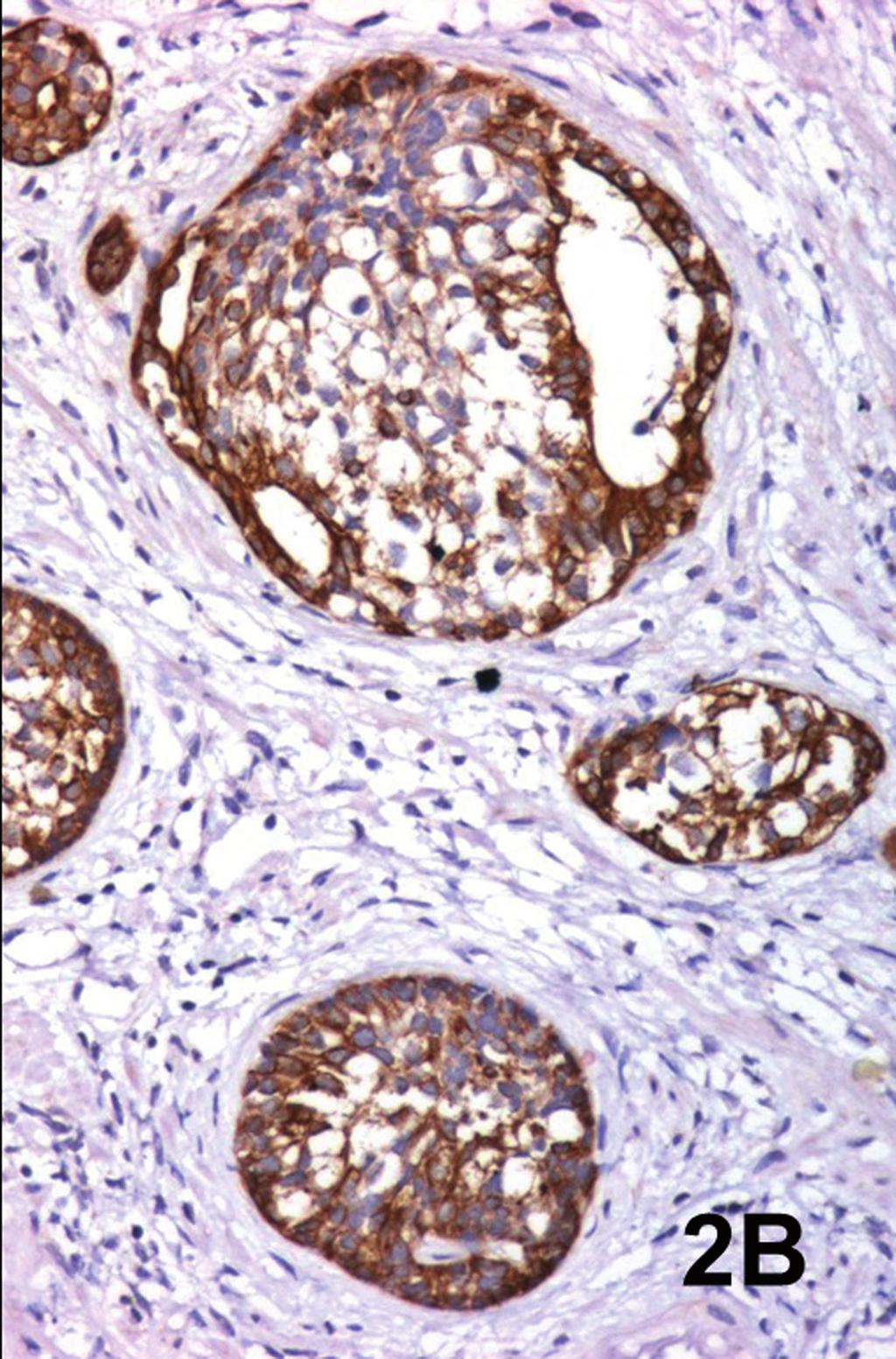 Note the nests of basophilic and clear cells with an irregular distribution. The stroma shows sclerosis and chronic inflammation. (Hematoxylin & Eosin. Original magnification x 95).