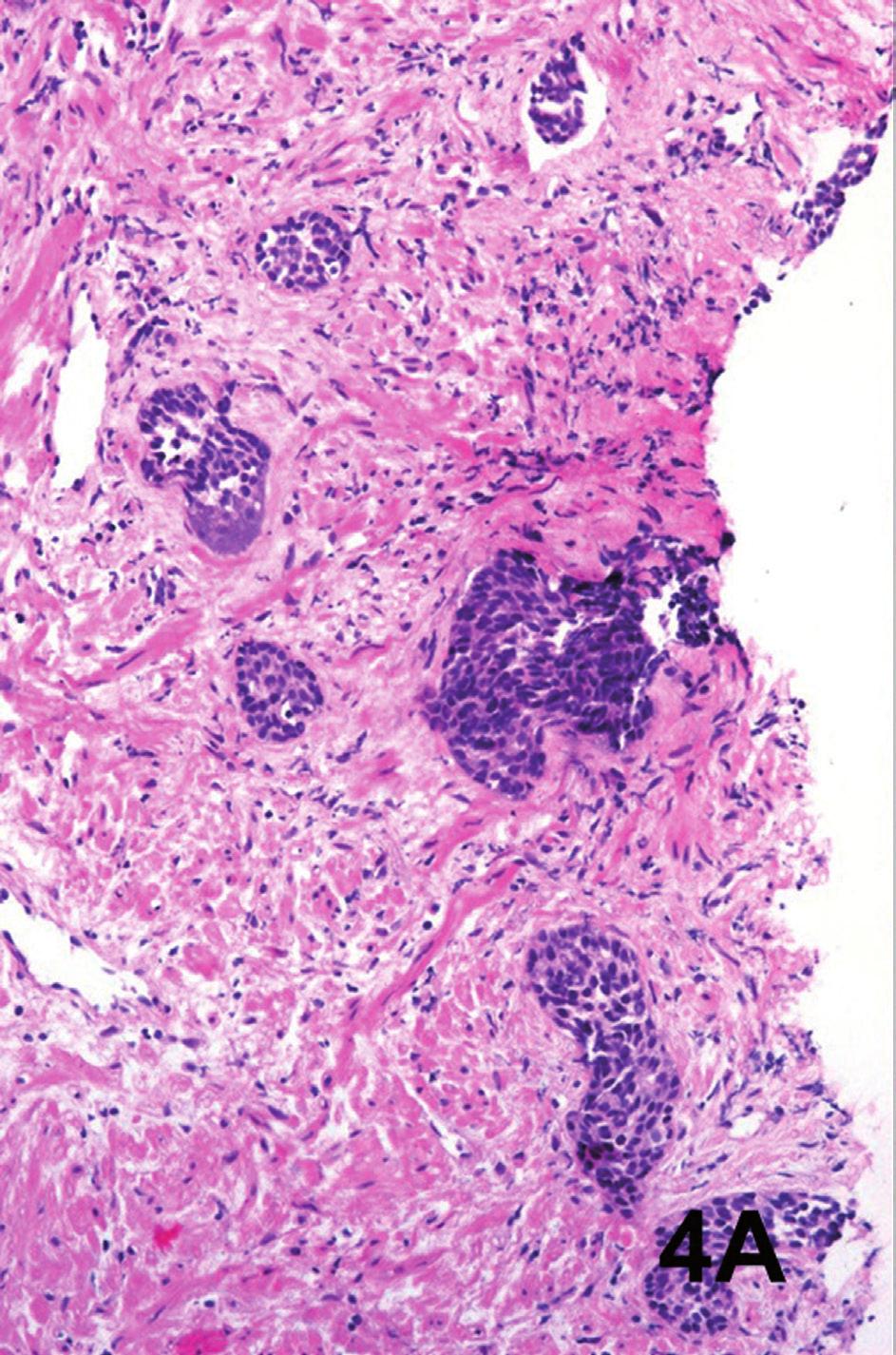 ibju Low grade urothelial carcinoma in prostate biopsy Figure 3 A - Low grade urothelial carcinoma in an isolated histological field (case 2).