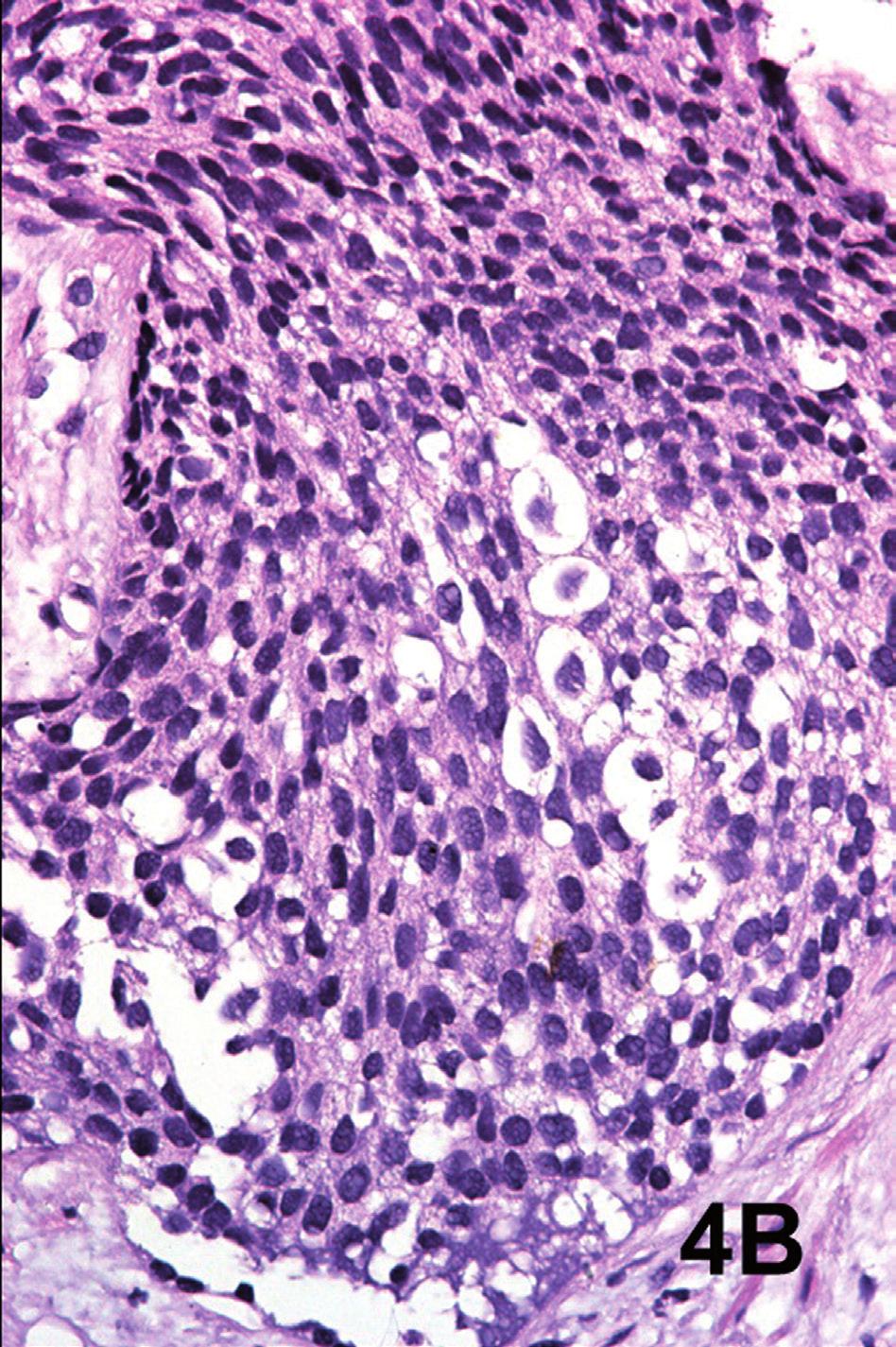 The neoplasm infiltrates ducts of varying diameter and comedonecrosis is observed in a mayor duct.