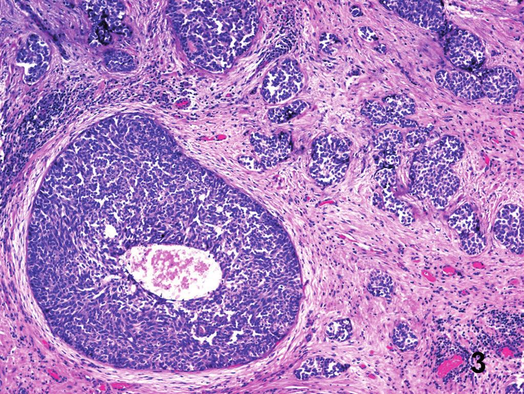 3A Figure 3 B - Low grade urothelial carcinoma simulating transitional cell metaplasia in needle biopsy. The cells are slightly atypical and show perinuclear clearing (Hematoxylin & Eosin.