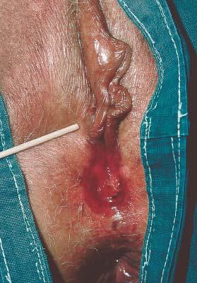 Hidradenoma papilliferum Clinical: Usually solitary, small and asymptomatic Occasionally can be a large and elevated, reddish-brown