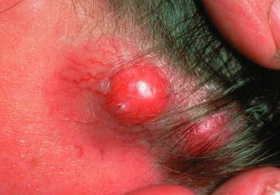 Cylindroma Clinical: Sporadic, solitary, nodular, red to tan lesion Most patients in 2 nd -4 th decade, females>males 90%
