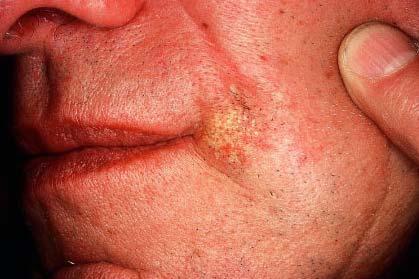 Microcystic adnexal carcinoma (MAC) Clinical: Solitary, indurated, slow-growing, ill-defined plaque Middle-aged adults, women>men Occur on the face with a predilection for the