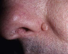 Trichoepithelioma Clinical: Skin-colored papule on the face Can be solitary and sporadic or multiple and associated with different syndromes Multiple familial trichoepithelioma (AD) Brook-Spiegler