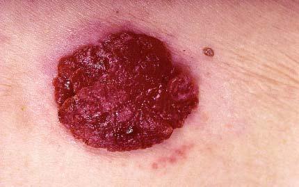 Poroma Clinical: Solitary, sessile, skin-colored to red, slightly scaly nodule Usually occur in adults, males=females Most often