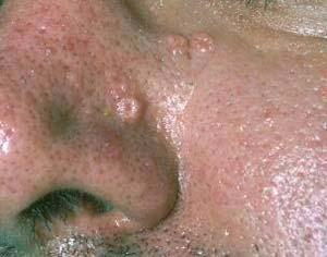Sebaceous hyperplasia Clinical: Usually occurs on the face of older individuals May occur as single lesions or in groups