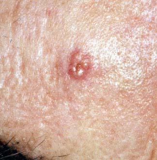 Sebaceous adenoma Clinical: Usually occurs in older individuals Tan, pink-red or yellow papulonodule Occasionally