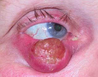 Sebaceous carcinoma Clinical: Ocular (approx.