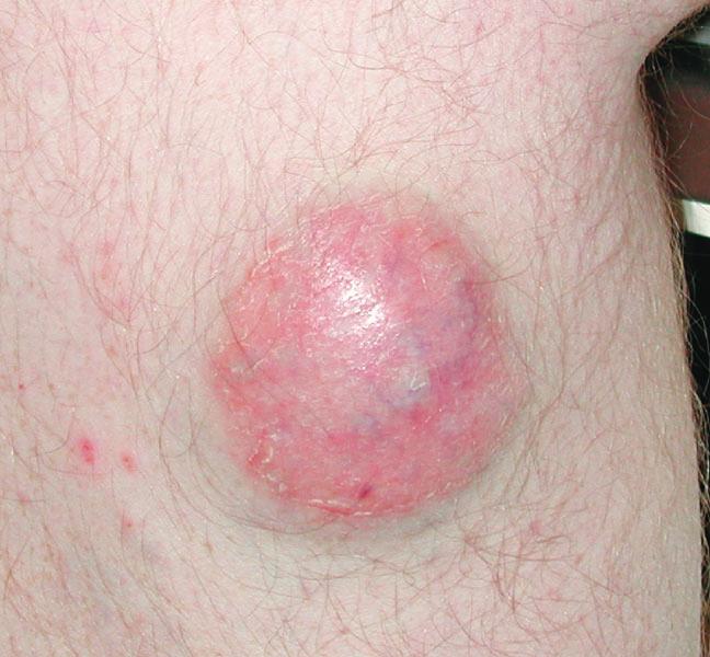 A blue-cell tumors including melanoma and lymphoma. The second most common pattern is the small cell type.