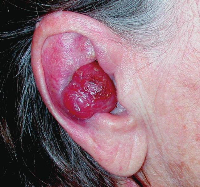 It has a latticelike, or network appearance, and the differential diagnosis includes metastatic carcinoid tumor.