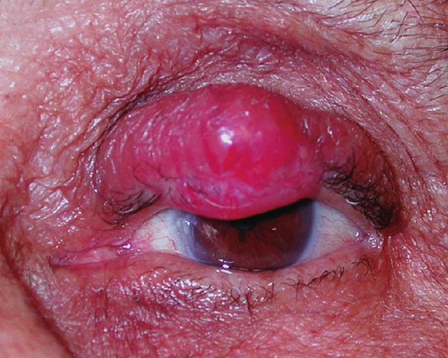 % Patients with no recurrence A 100 80 60 40 20 0 Recurrences: ~ 90% occur by 2 years 2 4 6 8 10 Time (years) A C FIGURE 120-4 Prognosis of Merkel cell carcinoma depends on stage at presentation. A. Fraction of patients with Stage I, II, or III disease with no recurrence.