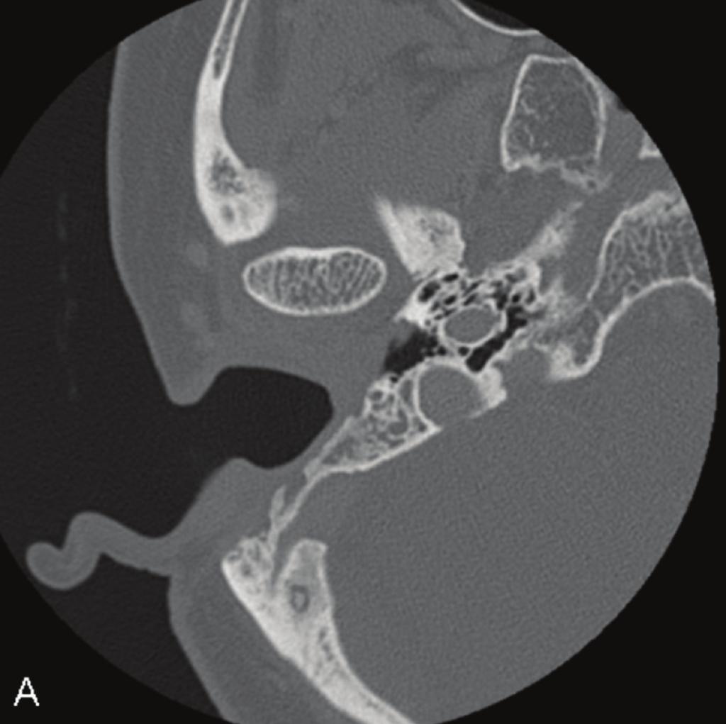 2 Figure 1: Six months after surgery in Case 1. An axial CT image showed that the EAC had formed an open cavity with the mastoid bowl.