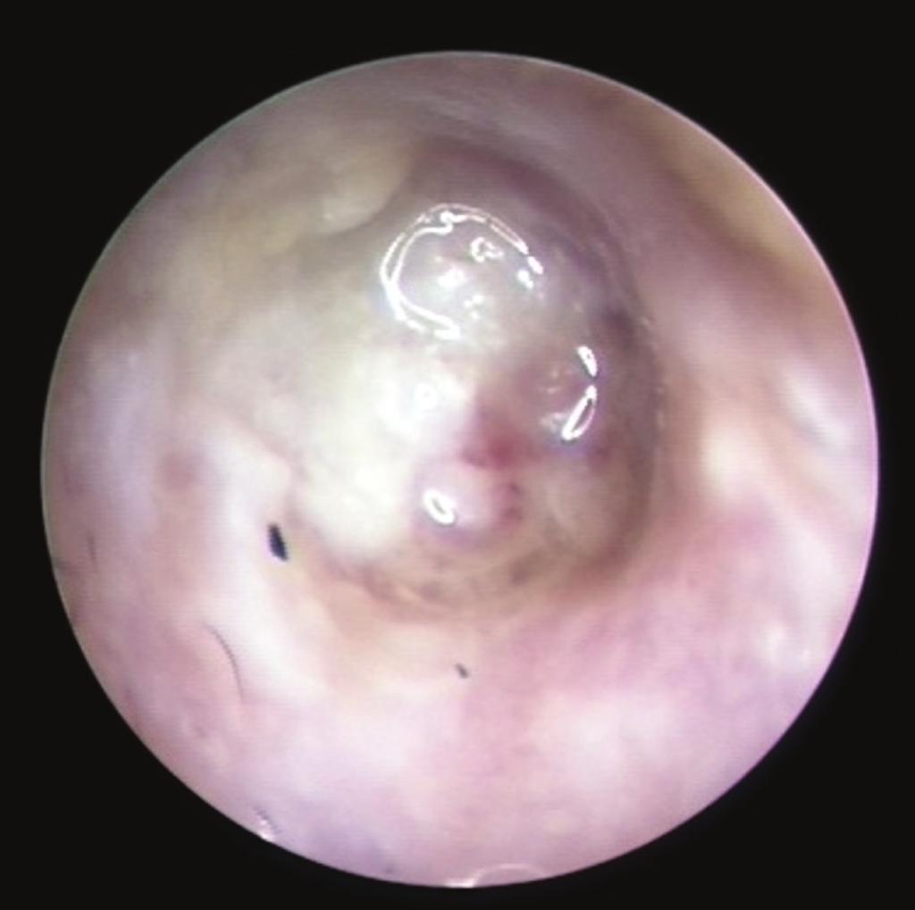 no evidence of bony erosion and no extension beyond the middle ear or surrounding tissue (T1N0M0). Lateral temporal bone resection with preservation of the stapes was performed.