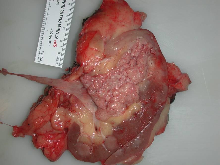 Imaging : JD s Right Kidney, Gross T3 N0 M0