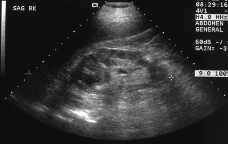 Imaging: JD s Right Upper Quadrant Ultrasound Sagittal