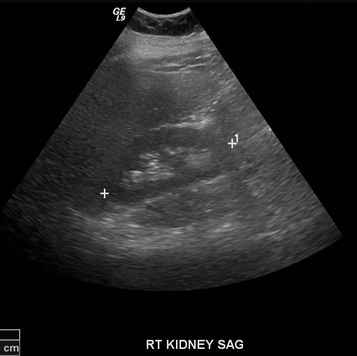 Imaging: Sagittal Right Kidney Ultrasound Patient JD