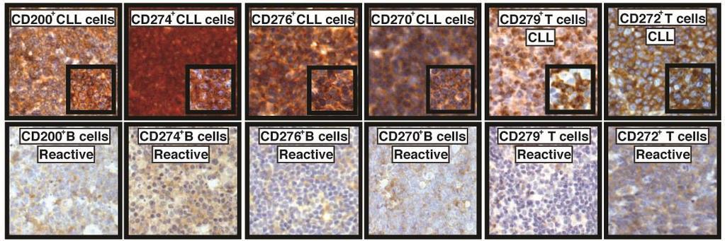 High expression of inhibitory ligands on Tumor cells and inhibitory receptors CD272 (BTLA) and CD279 (PD-1) on T cells In situ expression analysis using a CLL and FL TMA