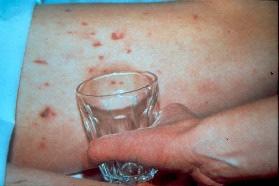 MENINGOCCAL SEPTICAEMIA AND MENINGITIS Signs and Symptoms Purpura and ecchymosis may develop very rapidly in fulminant cases It is important that all staff working in A&E familiarize themselves with