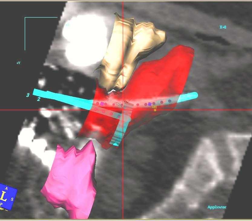 Third Attempt A flexible plastic HDR Tandem that can adapt better to the patient s uterus, and Ovoids,