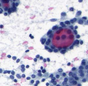Principles of thyroid FNA cytology Nuclear features of PTC Ratio cell:colloid and architectural pattern The