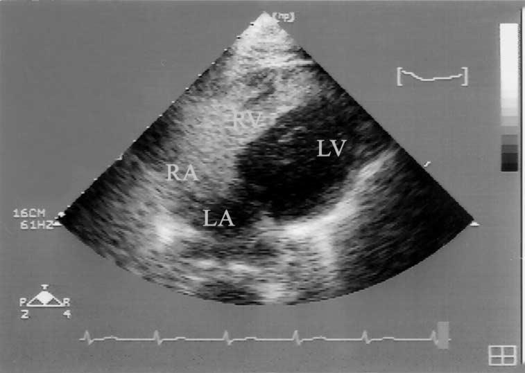 Figure 1. TTE with contrast injected into the basilic vein.
