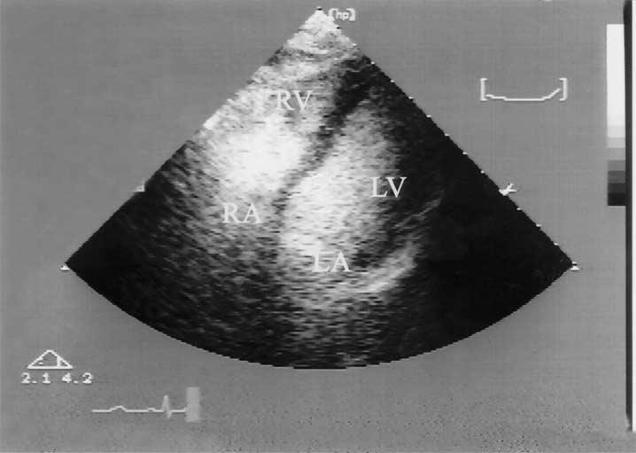 Figure 3. TTE with contrast injected into femoral vein.
