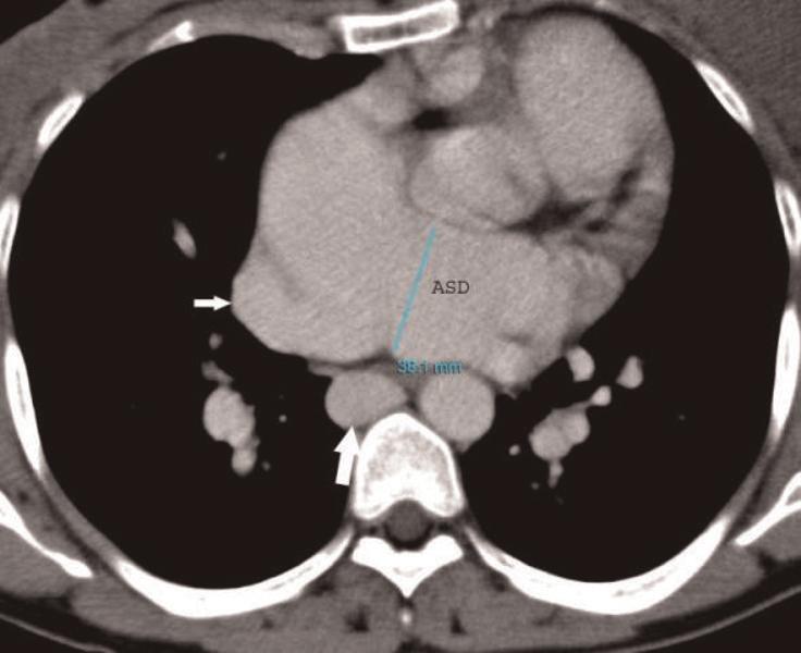Case presentation A 38-year-old woman from Elazig, Turkey with atrial septal defect was admitted for exertional dyspnea and fatigue.
