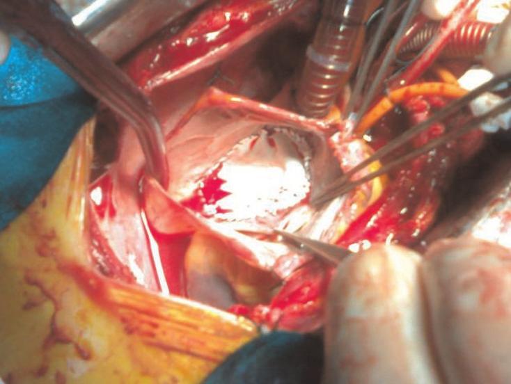 Infrahepatic IVC interruption withazygoscontinuation is a rare congenital anomaly, especially when it is not associated with congenital heart disease. Its prevalence is 0.6-2.