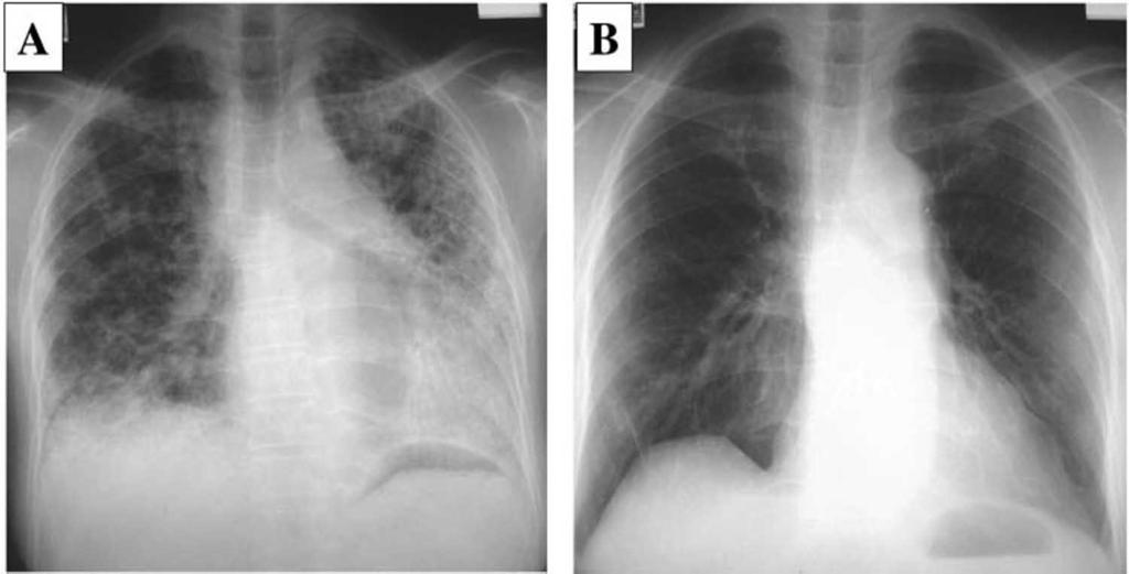 Figure 2. Chest radiographs of a 53-year-old woman with IIP. Left, A: before transplantation; right, B: 6 months after receiving LDLLT. Patient No.