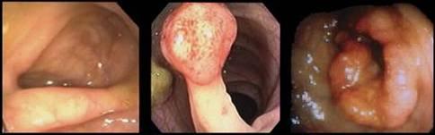 Normal to Adenoma to Carcinoma Human colon