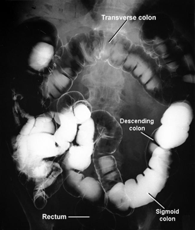 Double contrast barium enema (DCBE) In this test, a series of x-rays of the entire colon and rectum are taken after the patient is given