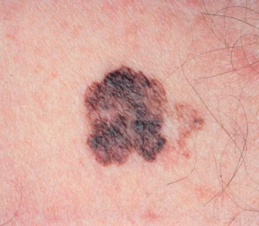 Melanomas The most serious form of skin cancer is melanoma.