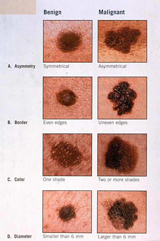Melanoma warning signs ABCD s Asymmetry Borders (irregular) Color