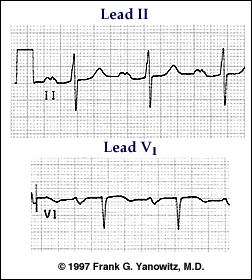 P Waves Right atrial enlargement (P pulmonale) Indicating right atrial