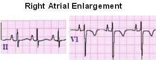 5 mm) P waves indicating left atrial enlargement (P mitrale) Notched P