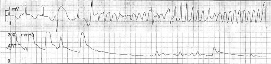 Prolonged QT Interval The QT interval reflects the time required for electrical activity to occur within the ventricle Includes both depolarization and repolarization Measure from beginning of QRS to