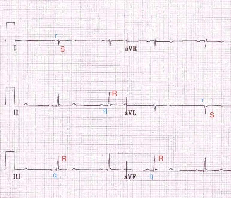 inferior leads (II, III, and avf) LPFB Right axis