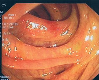 Endoscopy in SCAD Prospective study performed from January 2004 to October 2007: