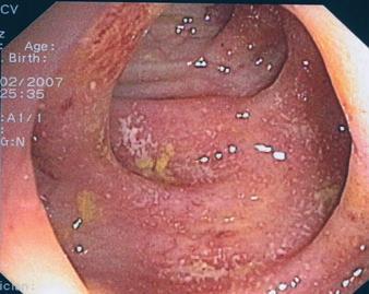Endoscopy in SCAD Prospective study performed from January 2004 to October 2007: 6230 colonoscopies, 92 SCAD (1.48%) Pattern B.