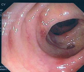Endoscopy in SCAD Prospective study performed from January 2004 to October 2007: 6230 colonoscopies, 92 SCAD (1.48%) Pattern C.