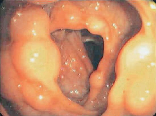 Pneumatosis intestinalis of the transverse